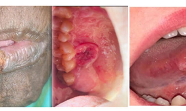 ಬಾಯಿಯ ಕ್ಯಾನ್ಸರ್ ತಡೆಗಟ್ಟುವುದು ಮತ್ತು ಶೀಘ್ರ ಪತ್ತೆ ಹಚ್ಚುವುದು: ಪ್ರಾಣ ರಕ್ಷಕ ದೃಷ್ಟಿಕೋಣ